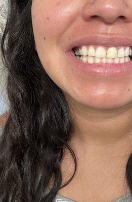 After Root Canal and 1 session internal bleaching.