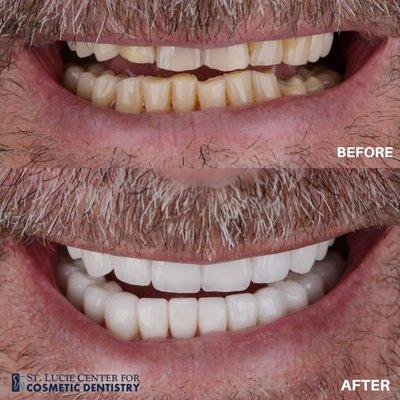 Crowns, Bridges, and Zoom Whitening Before and After