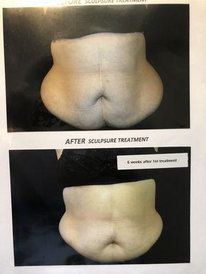 Before and After photo of SculpSure Treatment (actual client of Eze Health Center)