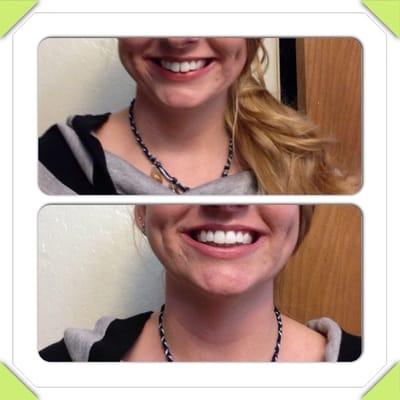 Teeth before and after a teeth bonding procedure to close the space in my front teeth. Painless and fast. :)