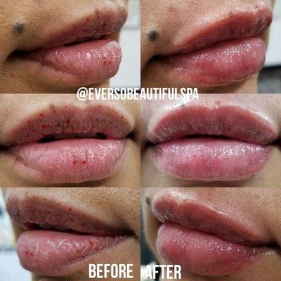 Hyaluron pen lip fillers