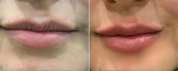 Our Beautiful patient's lips have been enhanced with 1ml of Volbella lip filler- Ask about the new client filler special