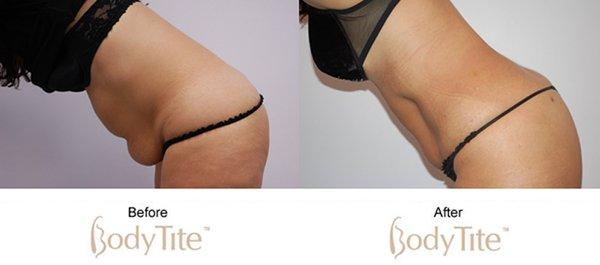 Bodytite (stomach); the latest non-surgical technology using radio frequency to stimulate collagen reproduction at 3 different dermal levels