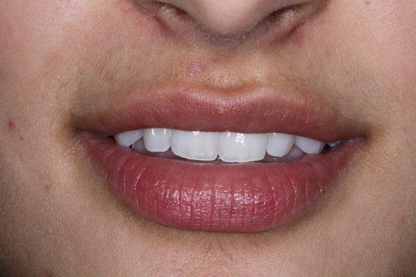 Natural restorations with esthetic nuances by Dr. Stevenson