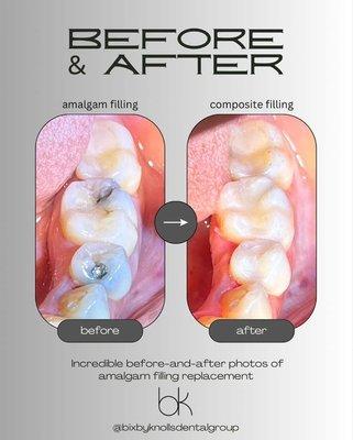 replace your old silver fillings with white composite fillings!