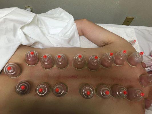 Cupping