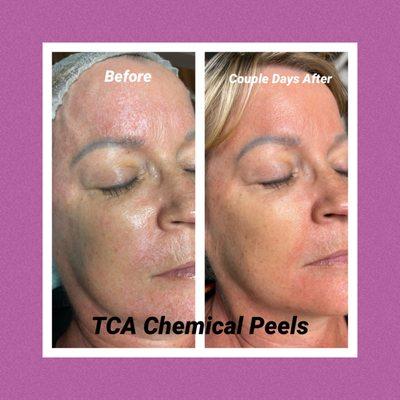 Now offering TCA Chemical Peels for deep exfoliation and evening skin tone