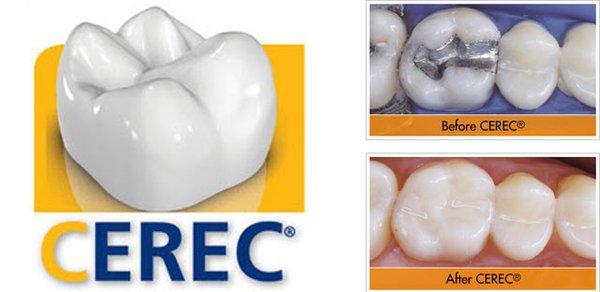 CEREC Same Day Crowns