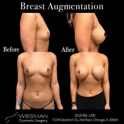 Breast Augmentation by Dr. Irvin Wiesman. Please call (312 )981-1290 to schedule your consultation!