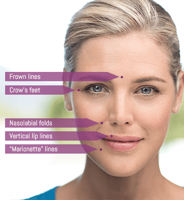 Botox $9/unit Dysport 2.85/unit