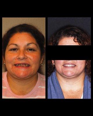 Smile Makeover