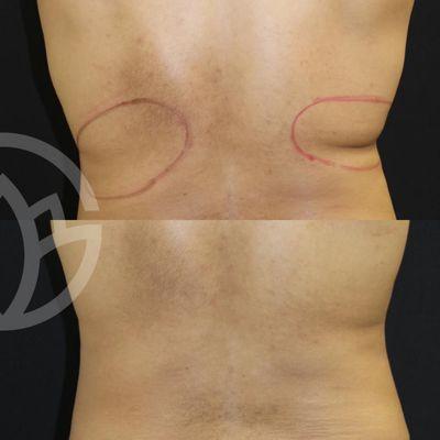 CoolSculpting results