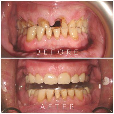 Restoration of the upper teeth with porcelain crowns.