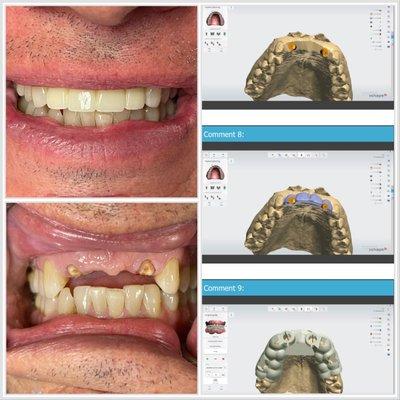 Front teeth were restored with implants using 3D guided surgery. This allows for safe and predictable implant placement.