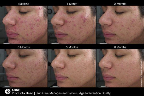 ACNE: Client sees dramatic results from only the Jan Marini products!