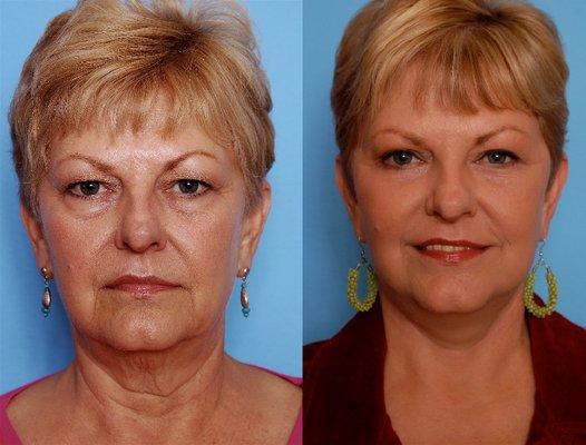 Facelift, neck lift, brow lift, blepharoplasty, CO2 laser