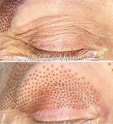 Upper eye lift