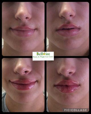 Lip filler