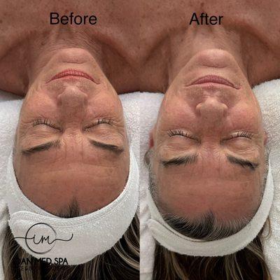 Before and after Non Surgical facelift treatment