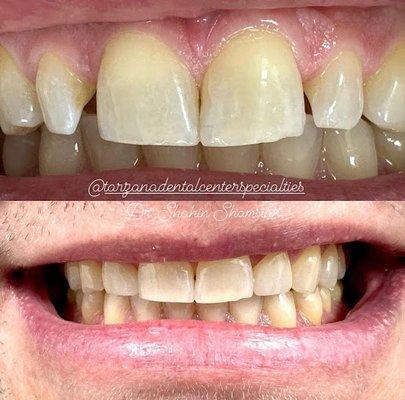 Before & After: 2 Zirconia crowns