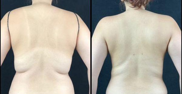 Upper back Vaser Lipo