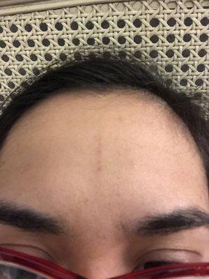 Broken capillaries from the massage made a red line on my forehead that has lasted for many hours so far.