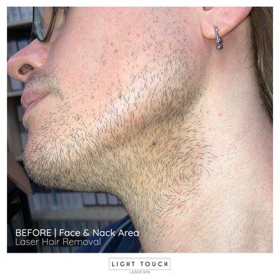 Before & After - Laser hair removal - facial area. Amazing results!