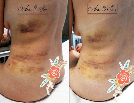 Reducing bruising, pain and discomfort 4 days after flank lipo. Before and after 1 session!