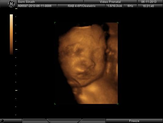 Prenatal Video 3D 4D HD Ultrasound