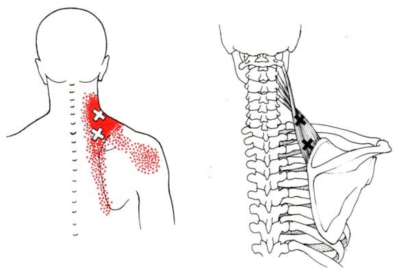 Trigger Point Referral for Levator Scapula/ Stiff Neck