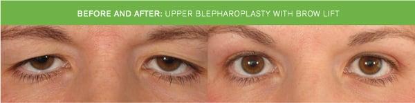 Before & After: Upper Blepharoplasty (Eyelift) with browlift