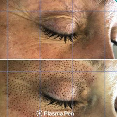 Plasma pen eyelid tightening .. non toxic,  non surgical skin tightening