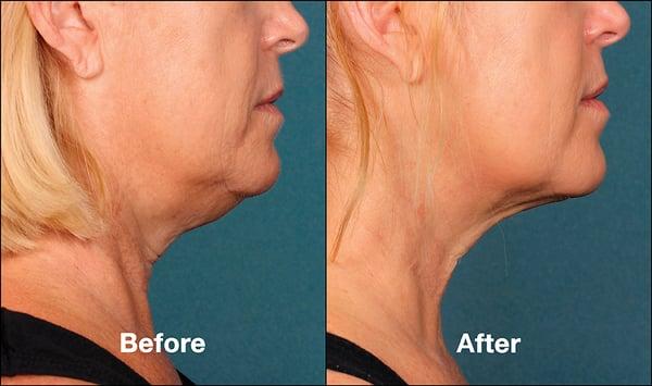 Neck Lift, Skin Tightening, RF Microneedling