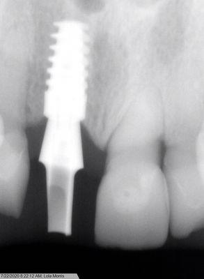 Front broken tooth replaced with implant/ abutment/ crown