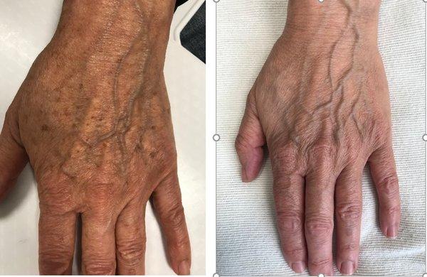 4 weeks after ONE IPL to treat sun damaged brown pigment on hands