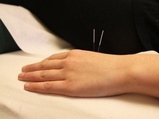 Acupuncture Treatments at Arogya