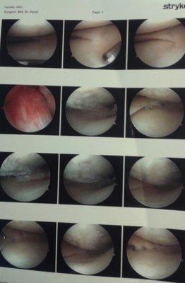 If you are a good patient, you get a free photo montage. I know they look like planets, but they're part of someone's knee--probably mne.