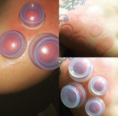 Cupping.