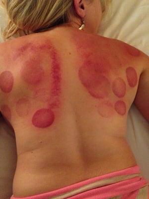 My back after getting cupping treatment. Felt so good! Better than a massage! It released all the tension in my shoulders!!!