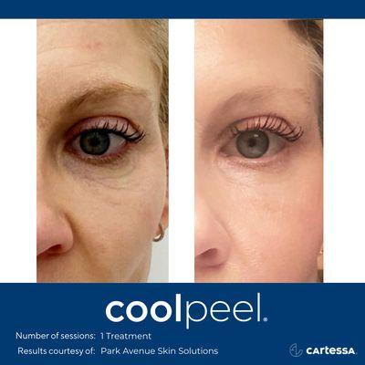 COOL PEEL LASER EYE TREATMENT