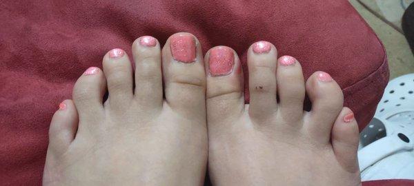 The right big toe on the right side where it's red is infected