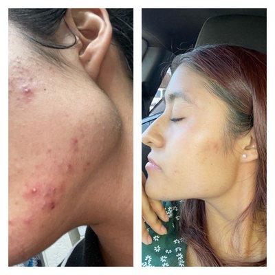 Janmarini resurfacing treatments