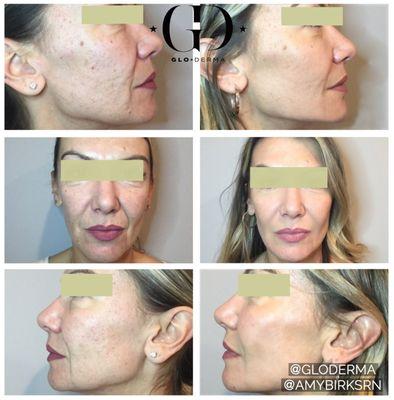 Vampire Facelift Before & After