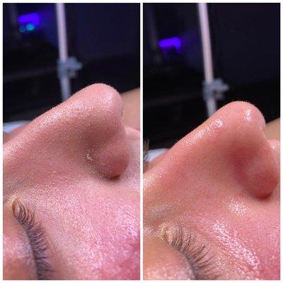 Hydrafacial