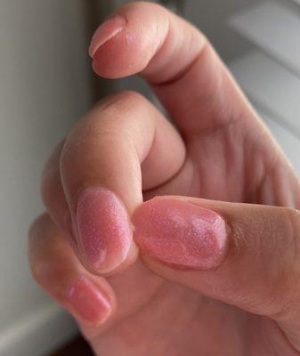 Hangnail left after manicure