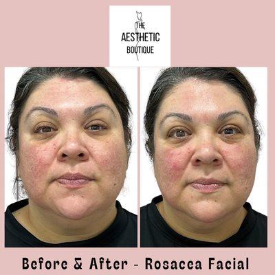 Rosacea Facial and Treatment Plan