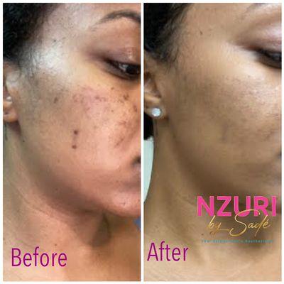 One session-Chemical Peel Results