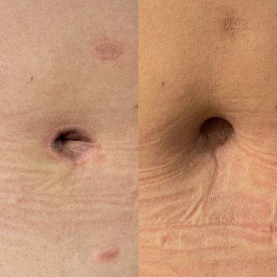 Belly Button Revision 3 Treatments in