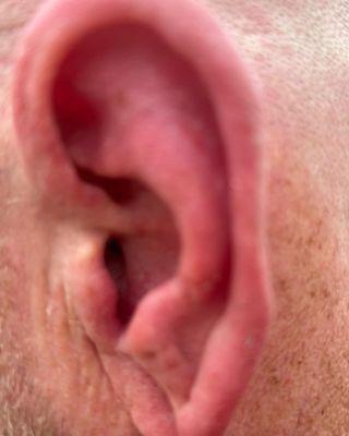 Ear wax $15
After