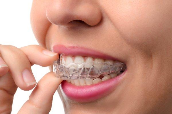 Clear aligners and Invisalign